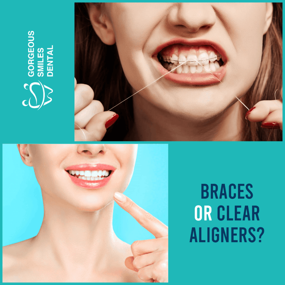 Dental Braces Options What Are The Best Options 2022