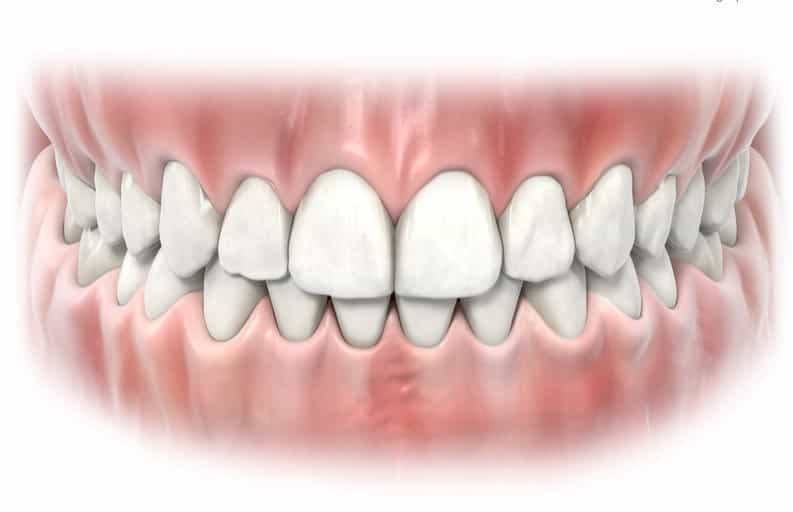 Gum Recession | What Can You Do For Your Gum Recession?