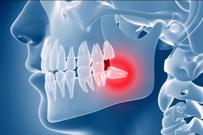 wisdom tooth