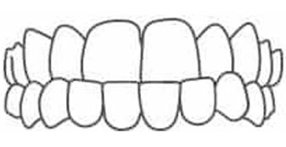 Underbite