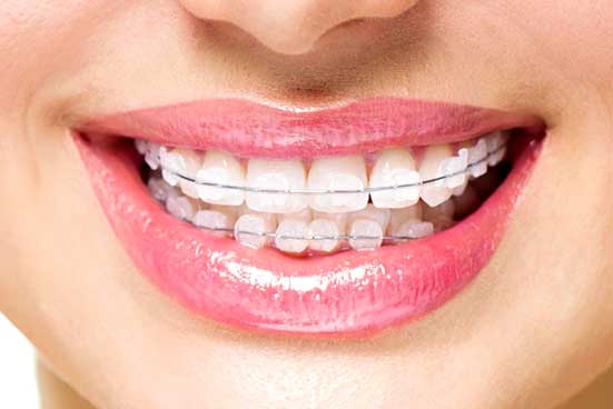 Bracket & Wire Placement