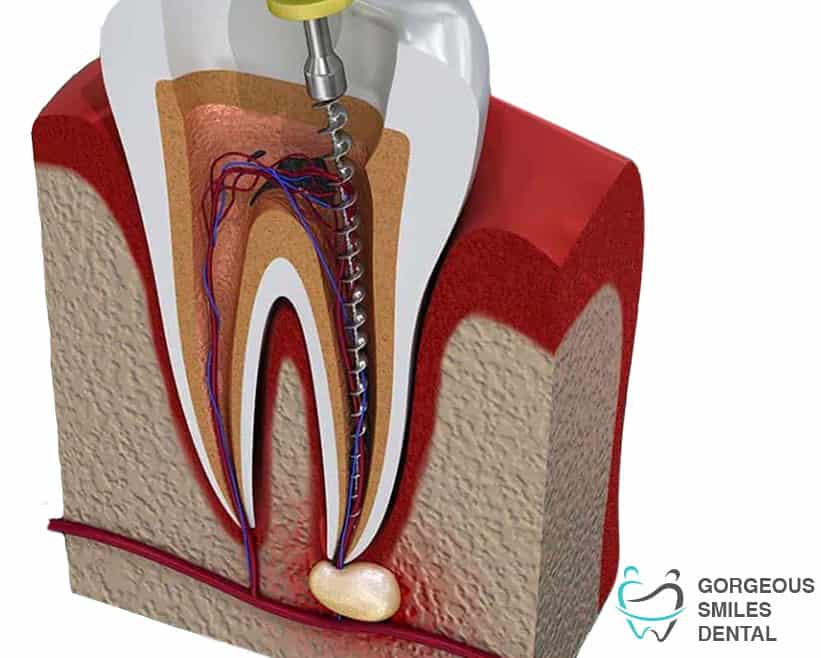 Cleaning out the infected pulp