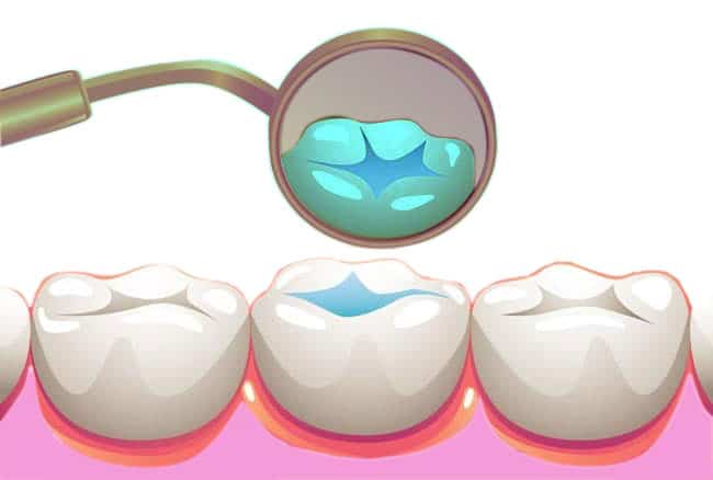 How Much Do Fissure Sealants Cost in Melbourne?