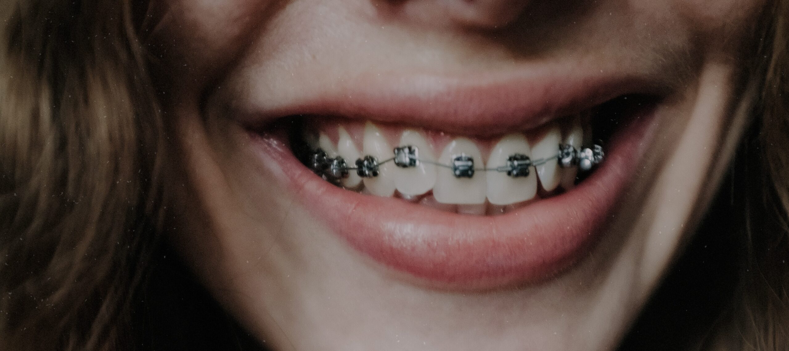 Metal Braces Melbourne