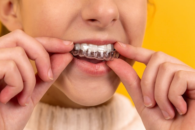 Veneers