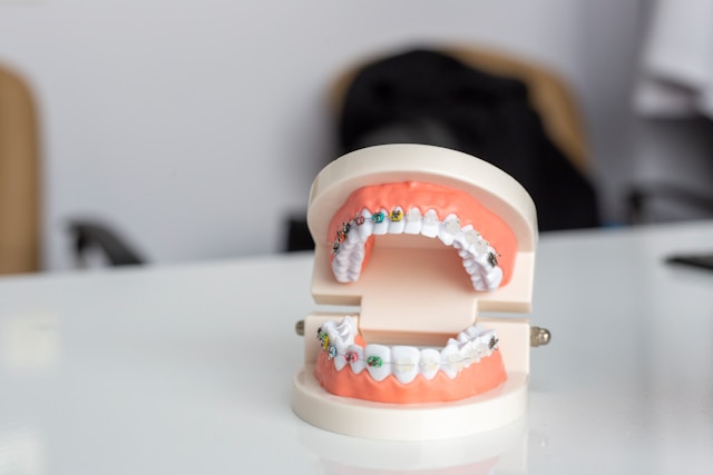 Braces For Gaps Between Teeth