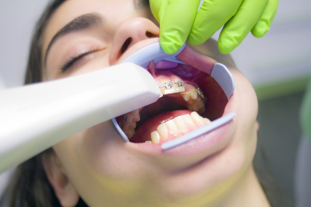Metal Braces VS Ceramic Braces