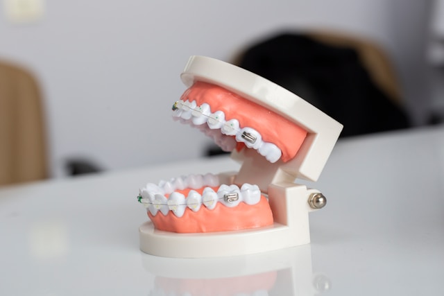 Metal Braces VS Lingual Braces