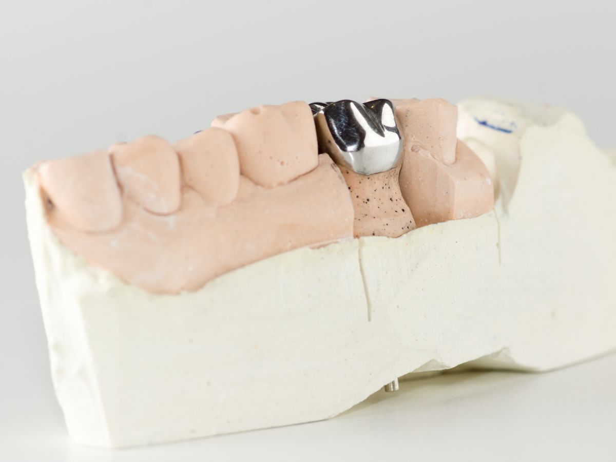 Metal Crowns