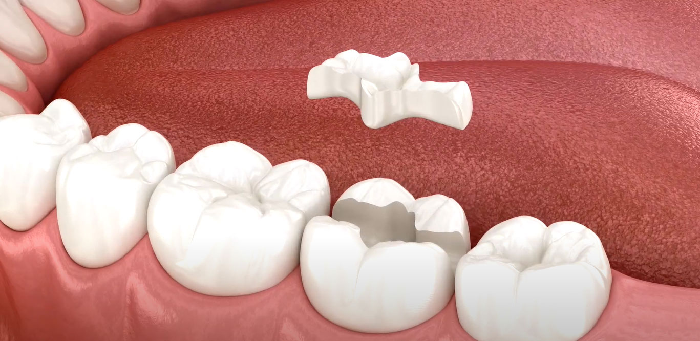 Tooth Preparation