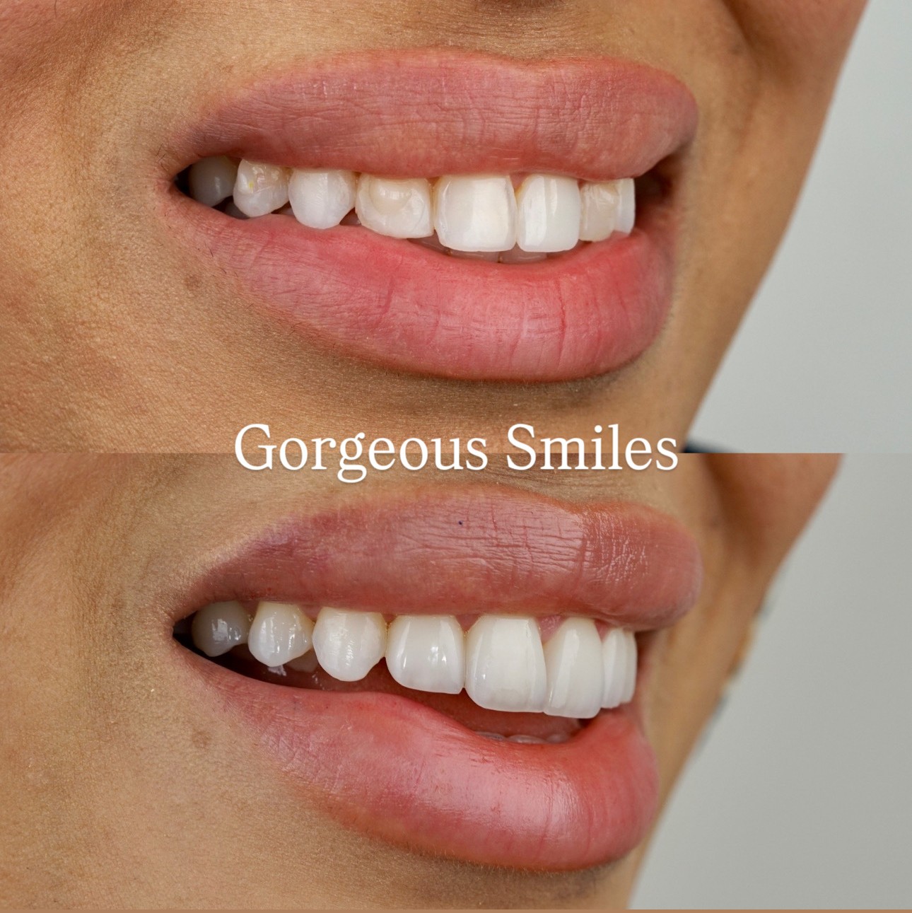 Treatment : 4 Porcelain Veneers ,Photo is Taken Almost 4 weeks After The Procedure