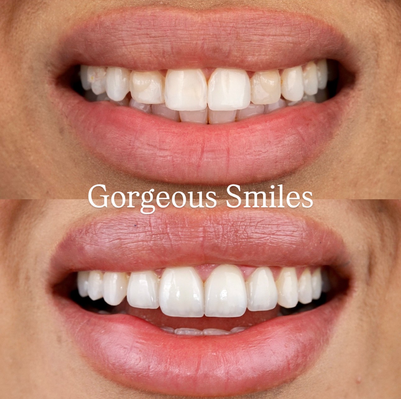 Treatment : 4 Porcelain Veneers ,Photo is Taken Almost 4 weeks After The Procedure