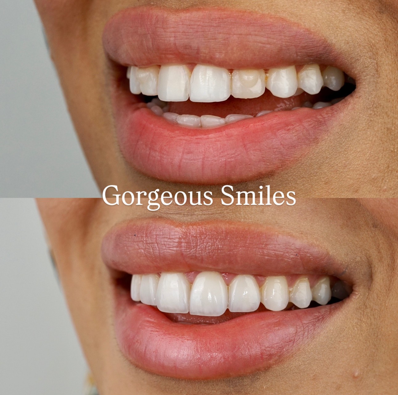 Treatment : 4 Porcelain Veneers ,Photo is Taken Almost 4 weeks After The Procedure