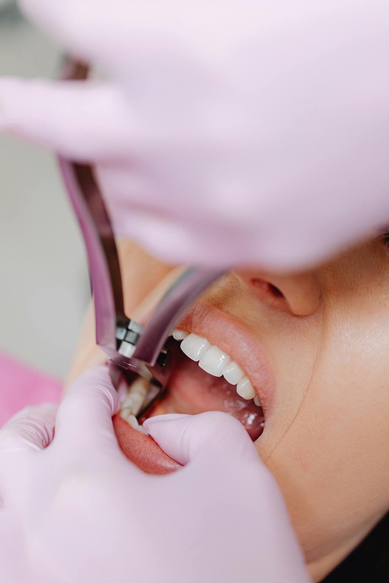 Tooth Extraction Treatment