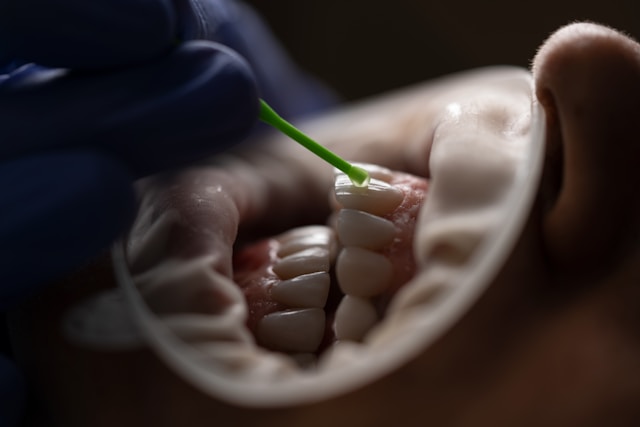 Composite Veneers