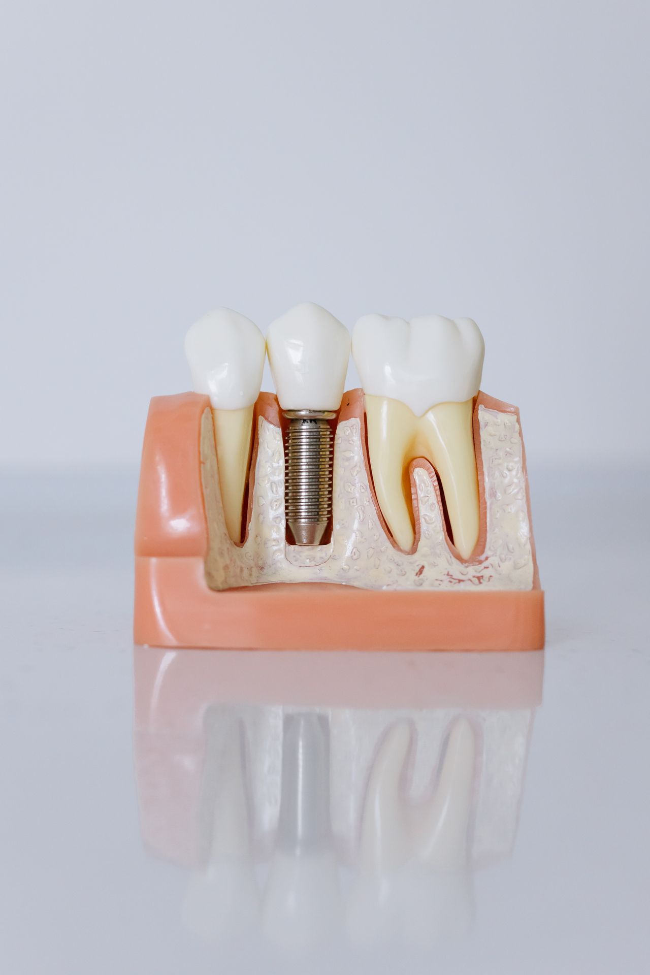 Single Dental Implants