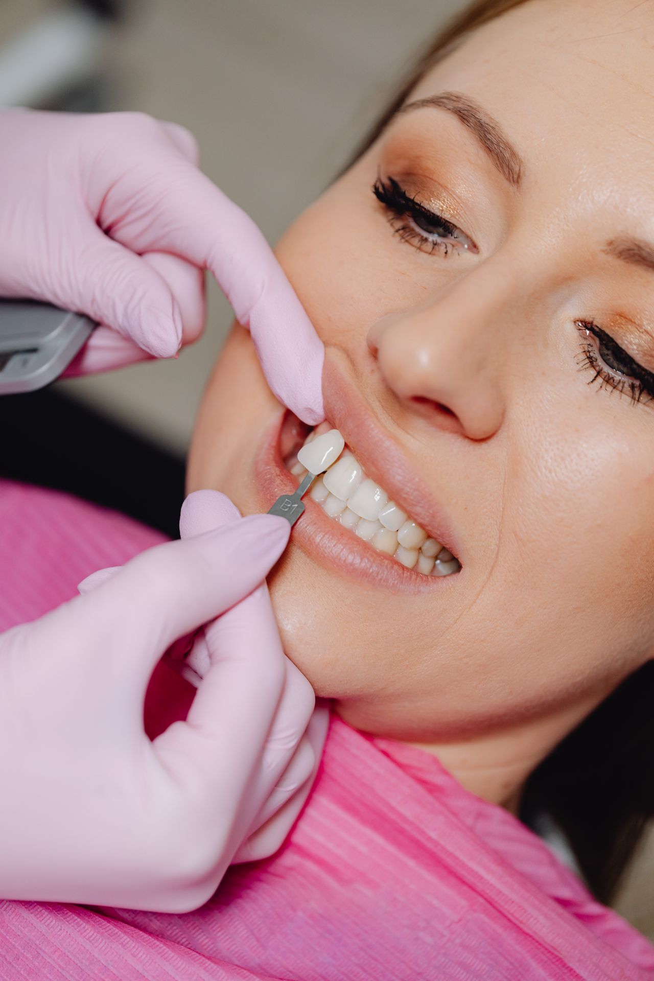 porcelain veneers